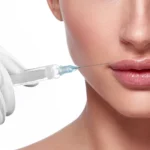 How to Prevent Bruising from Fillers