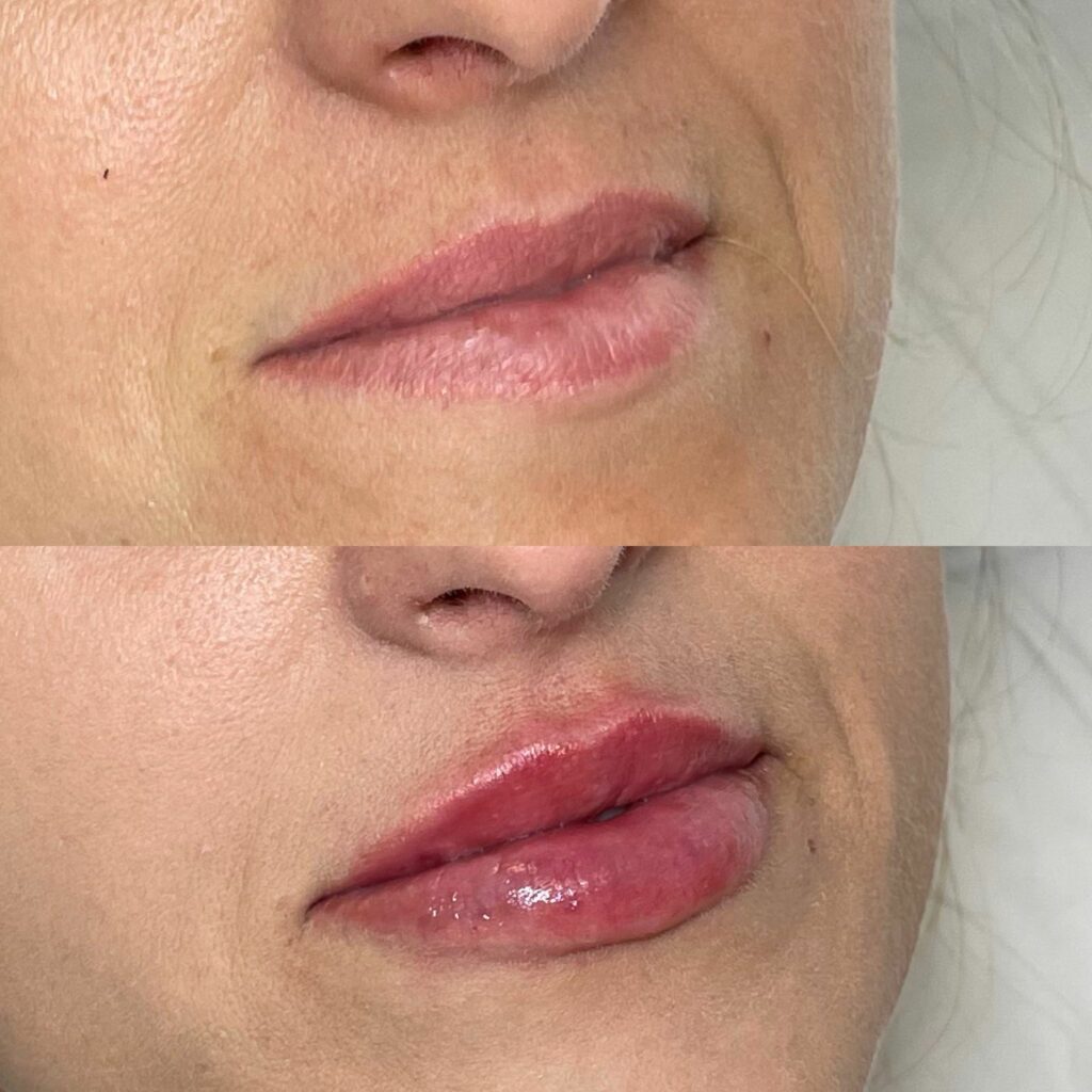 Lip Fillers, Anti-Wrinkle Injections in Abinger Common RH5